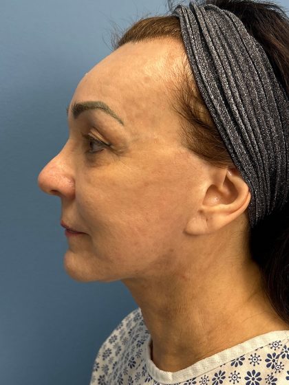 Browlift Before & After Patient #16464