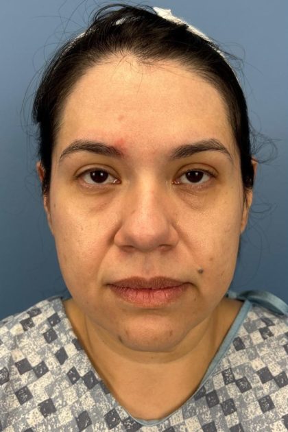 Browlift Before & After Patient #16692