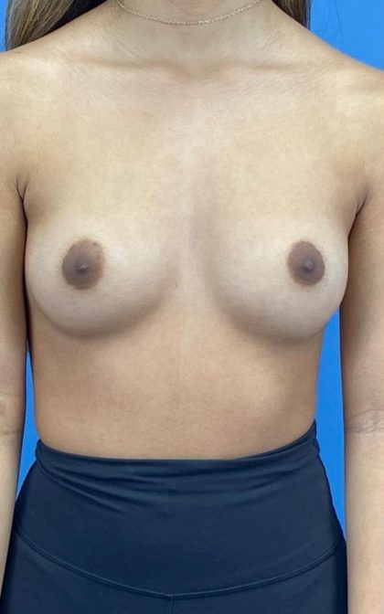 Breast Augmentation Before & After Patient #16755