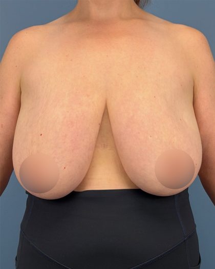 Breast Reduction Before & After Patient #16728
