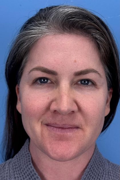 Browlift Before & After Patient #16681
