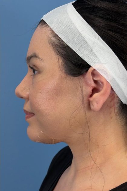 Browlift Before & After Patient #16692