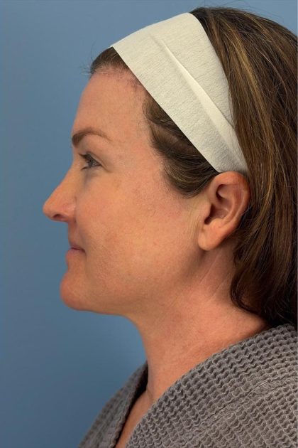 Browlift Before & After Patient #16681