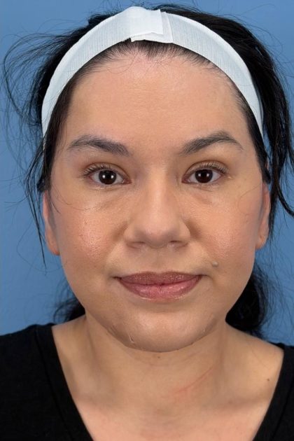 Browlift Before & After Patient #16692