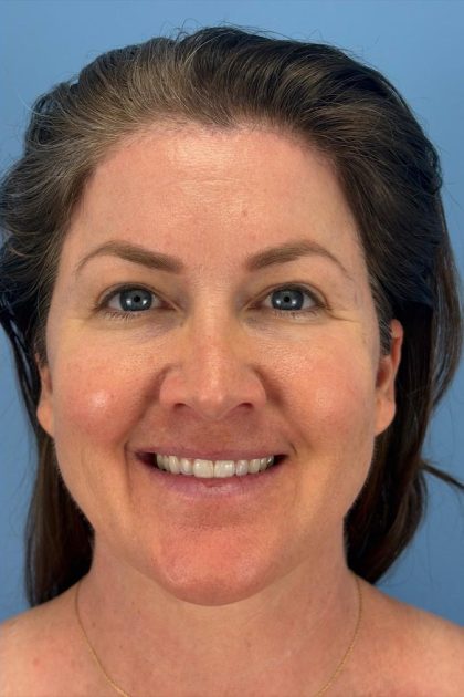 Browlift Before & After Patient #16681