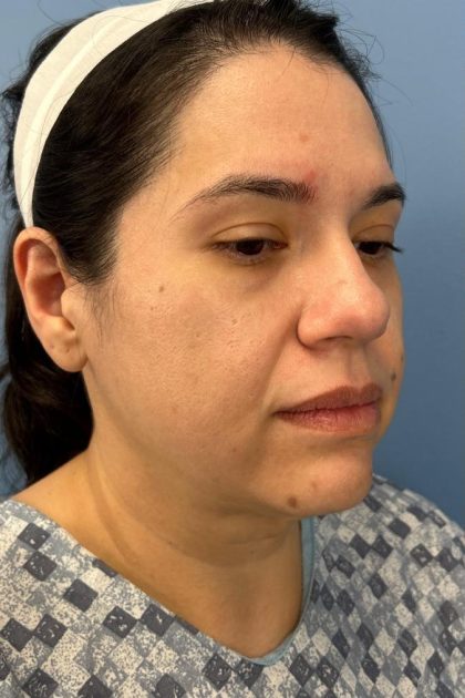 Browlift Before & After Patient #16692
