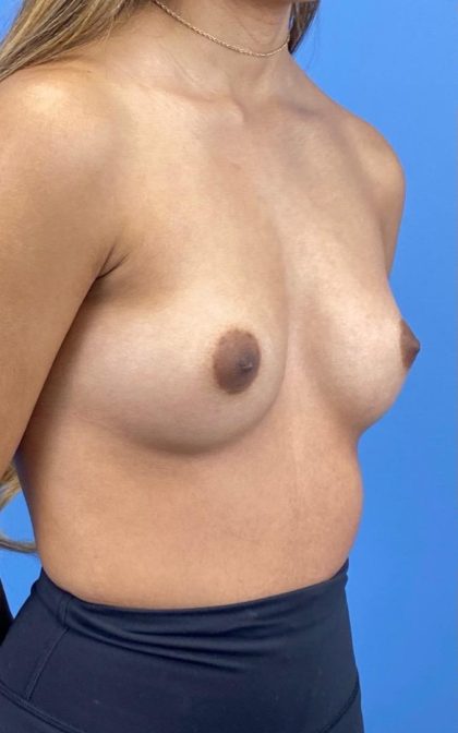 Breast Augmentation Before & After Patient #16755