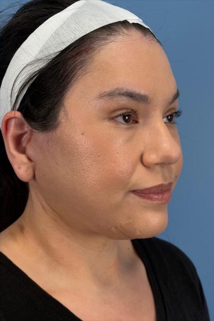 Browlift Before & After Patient #16692