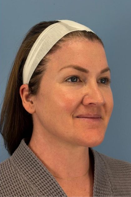 Browlift Before & After Patient #16681