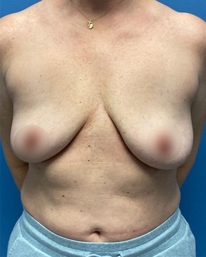 Breast Lift/Mastopexy Before & After Patient #16706