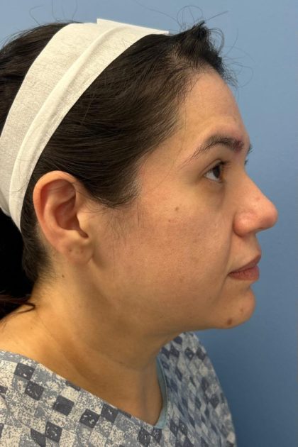 Browlift Before & After Patient #16692