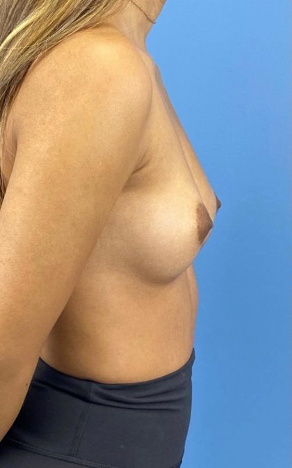 Breast Augmentation Before & After Patient #16755