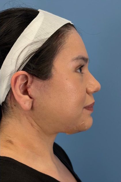 Browlift Before & After Patient #16692