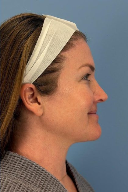 Browlift Before & After Patient #16681
