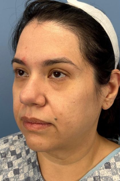 Browlift Before & After Patient #16692