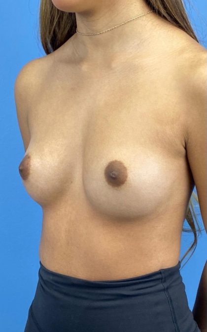 Breast Augmentation Before & After Patient #16755