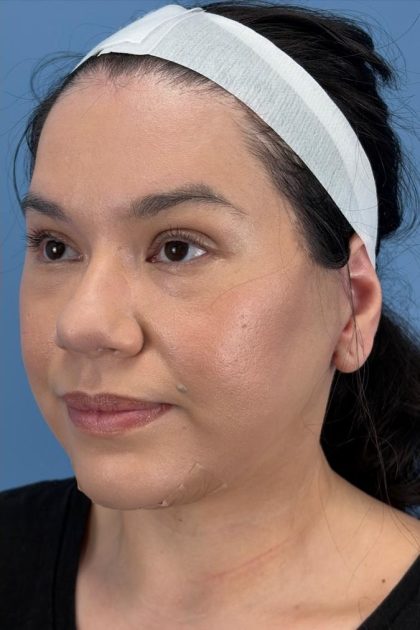 Browlift Before & After Patient #16692