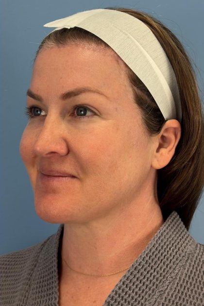 Browlift Before & After Patient #16681
