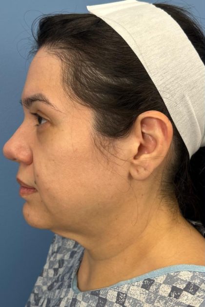 Browlift Before & After Patient #16692