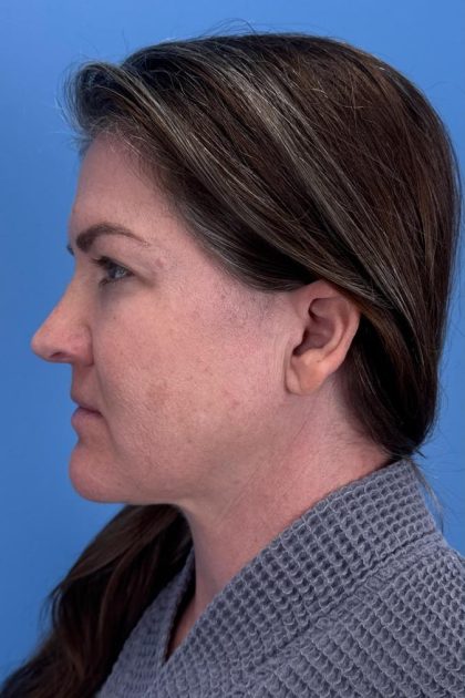 Browlift Before & After Patient #16681