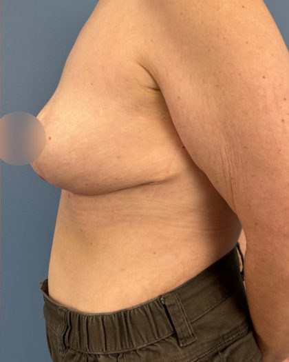 Breast Reduction Before & After Patient #16728