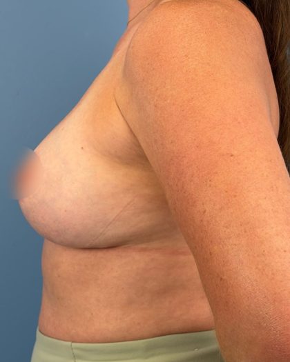 Breast Lift/Mastopexy Before & After Patient #16706