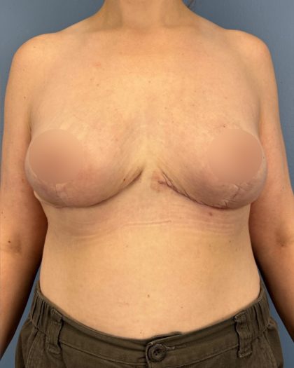 Breast Reduction Before & After Patient #16728