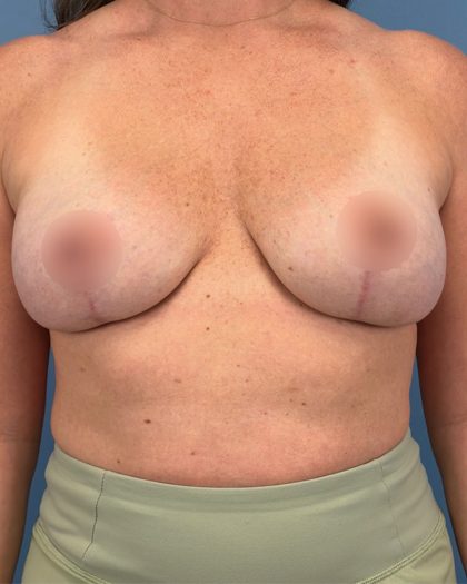 Breast Lift/Mastopexy Before & After Patient #16706