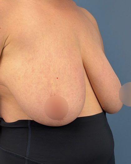Breast Reduction Before & After Patient #16728