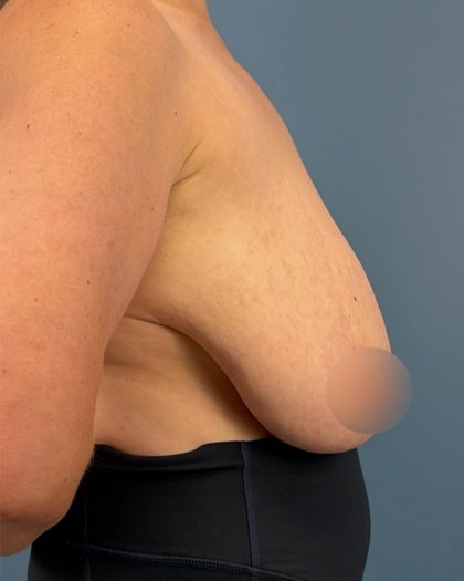 Breast Reduction Before & After Patient #16728
