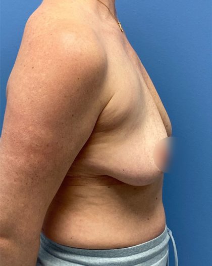 Breast Lift/Mastopexy Before & After Patient #16706