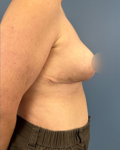 Breast Reduction Before & After Patient #16728