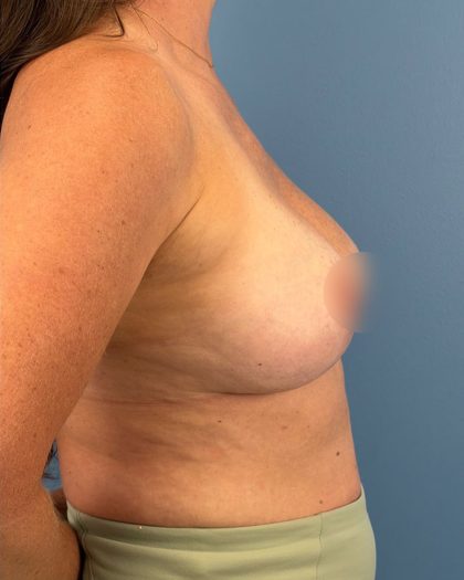 Breast Lift/Mastopexy Before & After Patient #16706