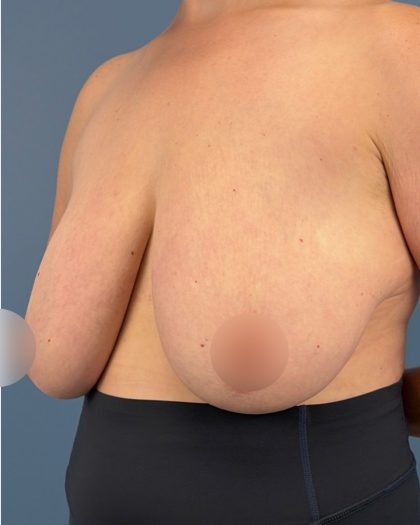 Breast Reduction Before & After Patient #16728