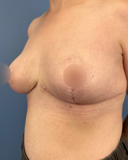 Breast Reduction Before & After Patient #16728