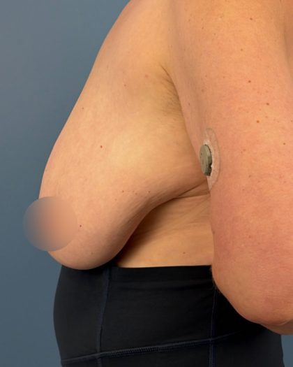 Breast Reduction Before & After Patient #16728