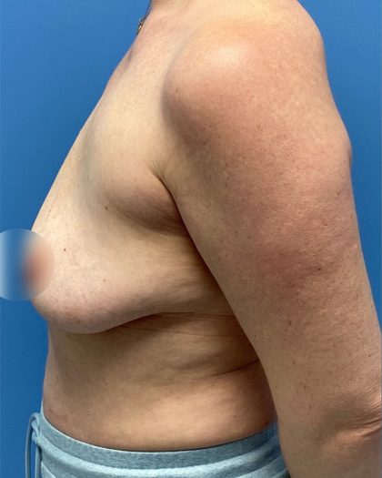 Breast Lift/Mastopexy Before & After Patient #16706