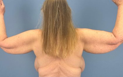 Arm Lift Before & After Patient #16746