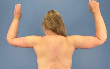 Arm Lift Before & After Patient #16746