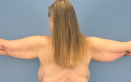 Arm Lift Before & After Patient #16746