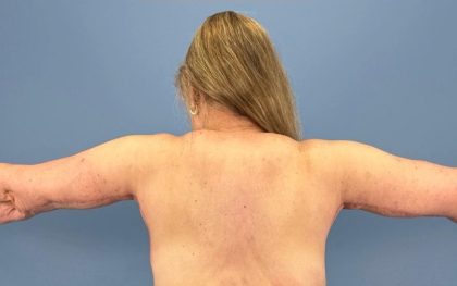 Arm Lift Before & After Patient #16746