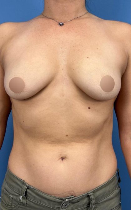 Breast Augmentation Before & After Patient #16737