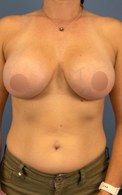 Breast Augmentation Before & After Patient #16737