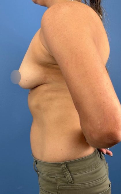 Breast Augmentation Before & After Patient #16737