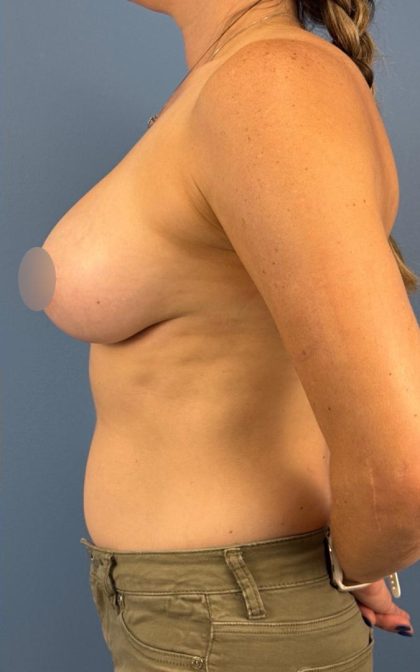 Breast Augmentation Before & After Patient #16737