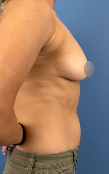 Breast Augmentation Before & After Patient #16737
