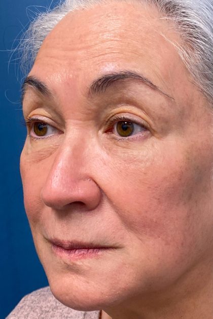 Blepharoplasty Before & After Patient #16983