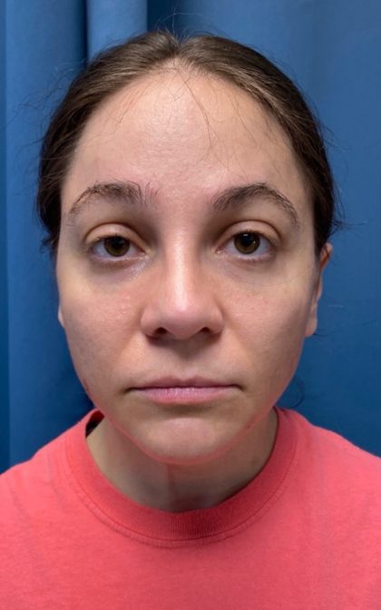 Browlift Before & After Patient #16917