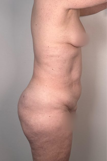 Breast Augmentation Before & After Patient #16980