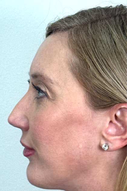 Blepharoplasty Before & After Patient #16982